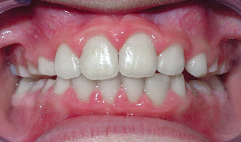 After Patient with an underbite, crossbite and crowding