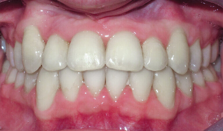 After Patient with a crossbite, underbite, and crowding