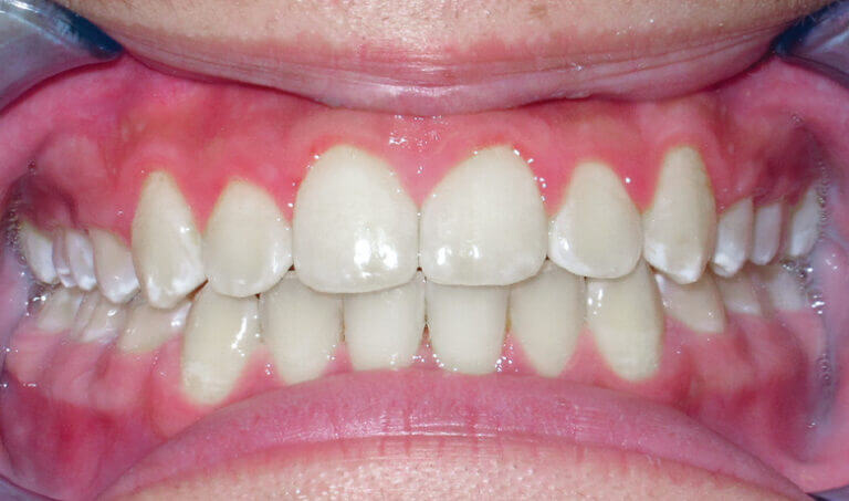 After Patient with crowding and protrusion