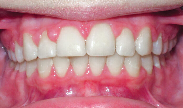 After Patient with an overbite, spacing and protrusion