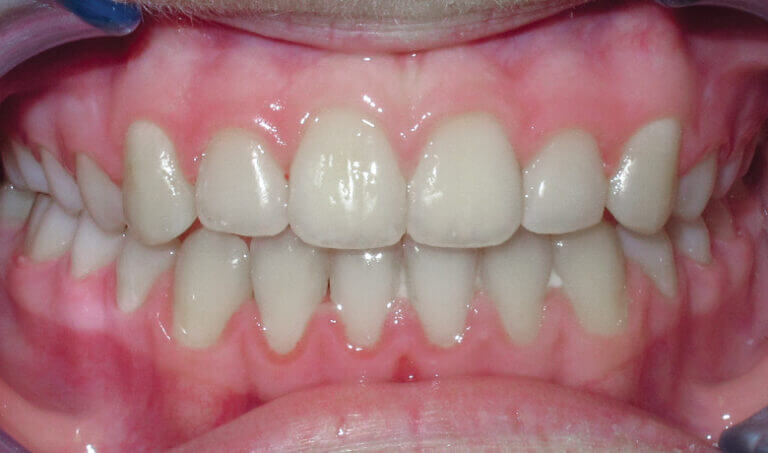 After Patient with an anterior crossbite, crowding and underbite tendency