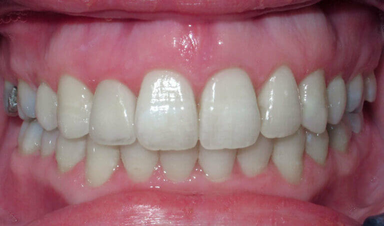 After Patient with a crossbite, openbite and crowding