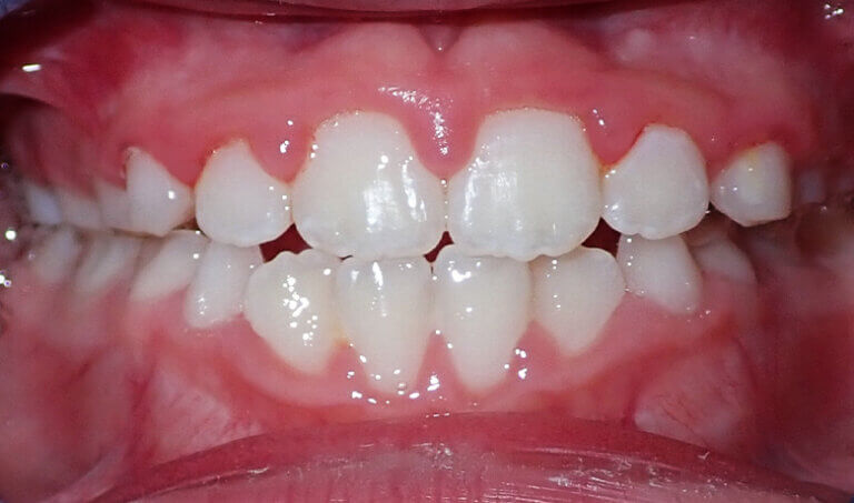 After Patient with crossbite and openbite