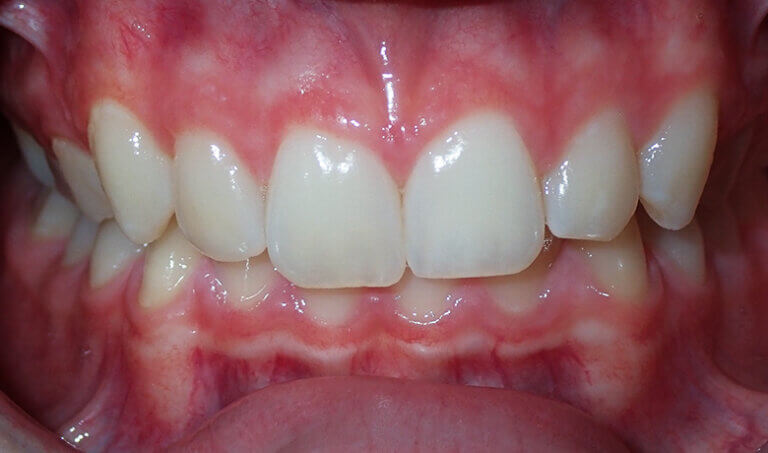 After Patient with overbite