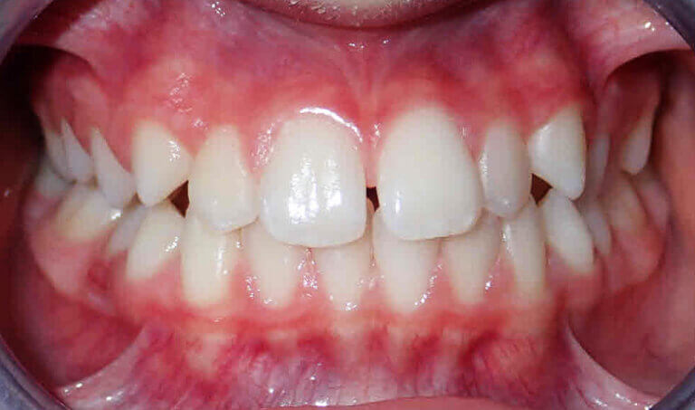 After Patient with overbite and crowding