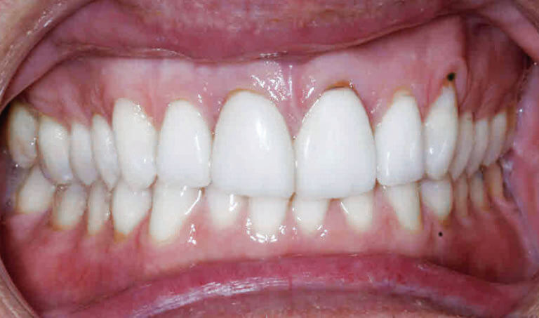 After Patient with overbite and crowding