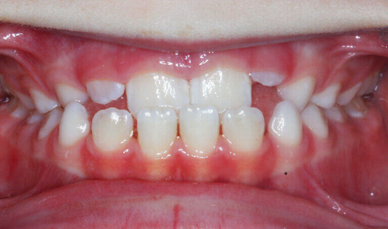 After Patient with crossbite and spacing