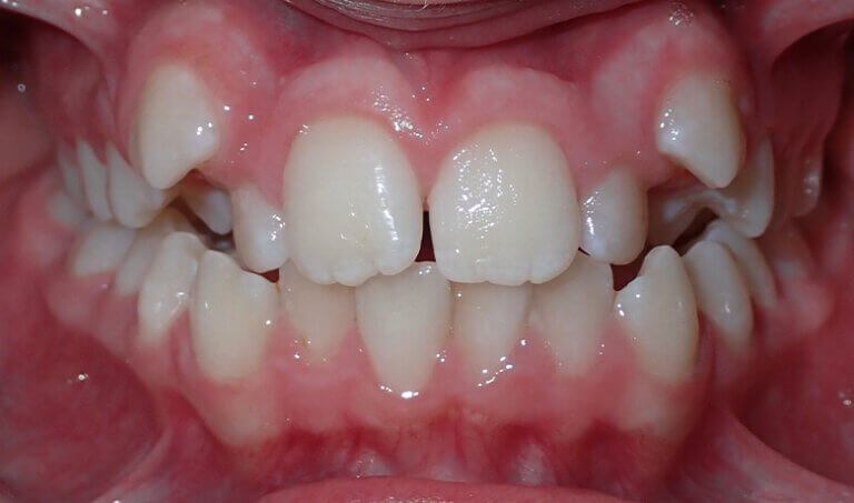 After Patient with crowding, openbite, and crossbite