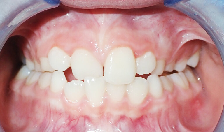 After Patient with crossbite