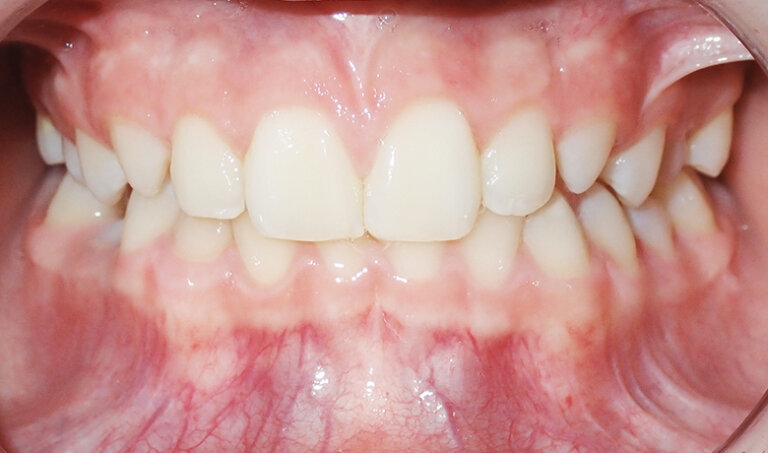 After Patient with crossbite