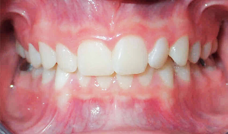 After Patient with overbite and crowding