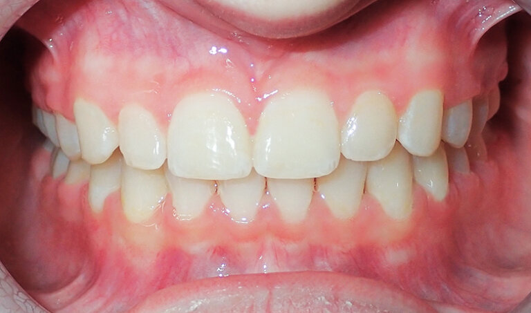 After Patient with overbite and crowding