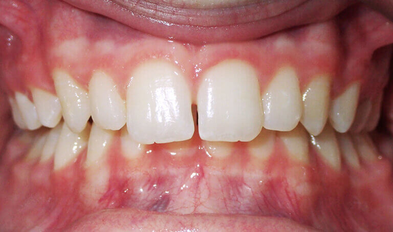 After Patient with mild deep overbite and mild crowding