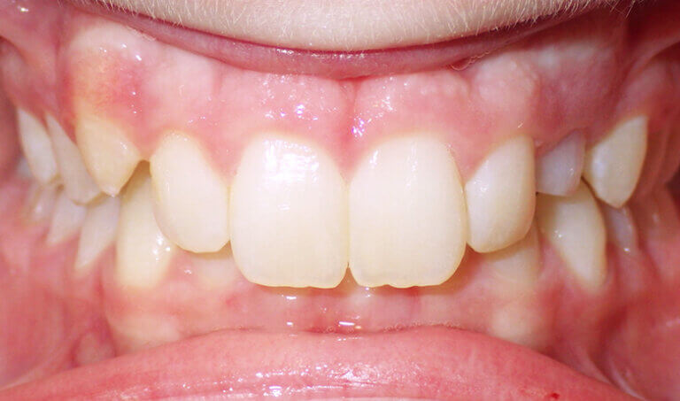 After Patient with deep overbite