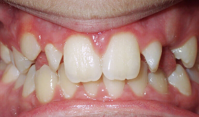 After Patient with deep bite (overbite)