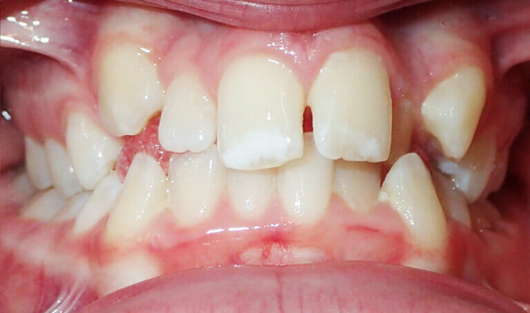 After Patient with deep bite (overbite) and crowding