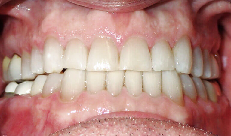 After Patient with spacing edge to edge bite