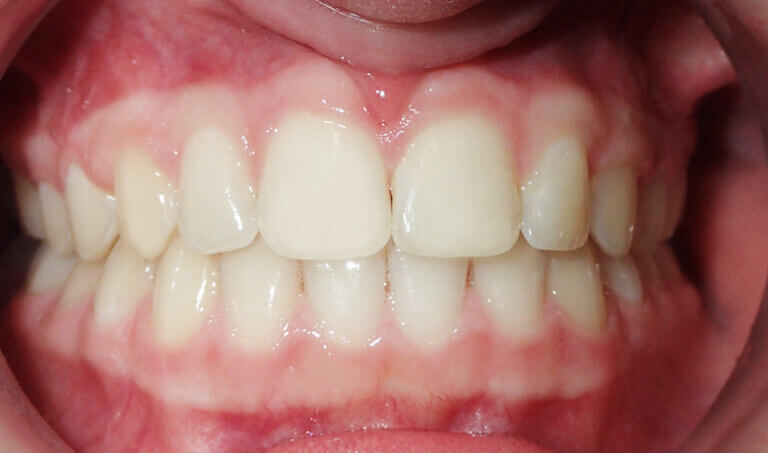 After Patient with openbite
