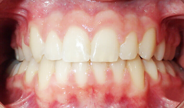 After Patient with moderate crowding and deep overbite