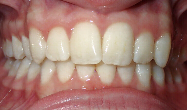 After Patient with moderate deep overbite and crowding