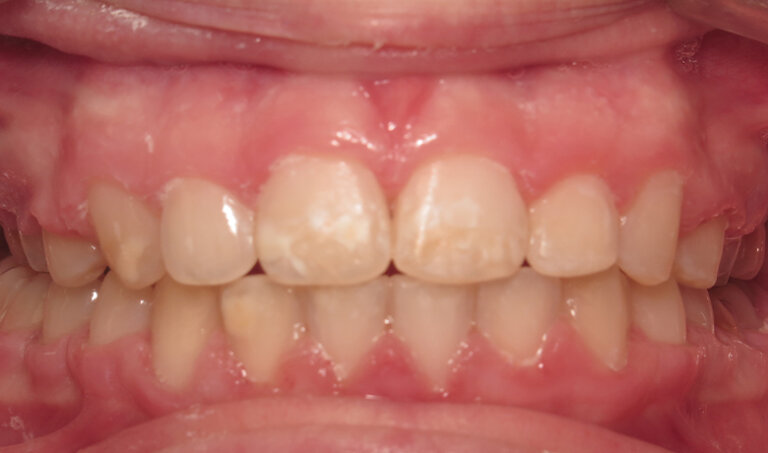 After Patient with overjet and crowding