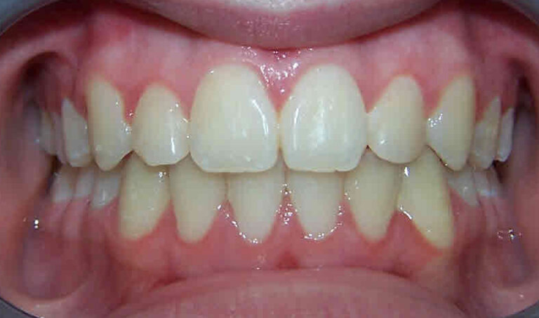 After Patient with an overbite