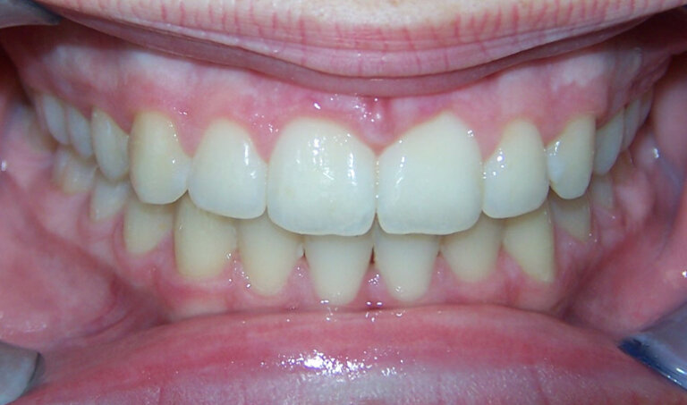 After Patient with an overbite